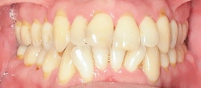 Vorher-Nacher Zahnkorrektur - vorher